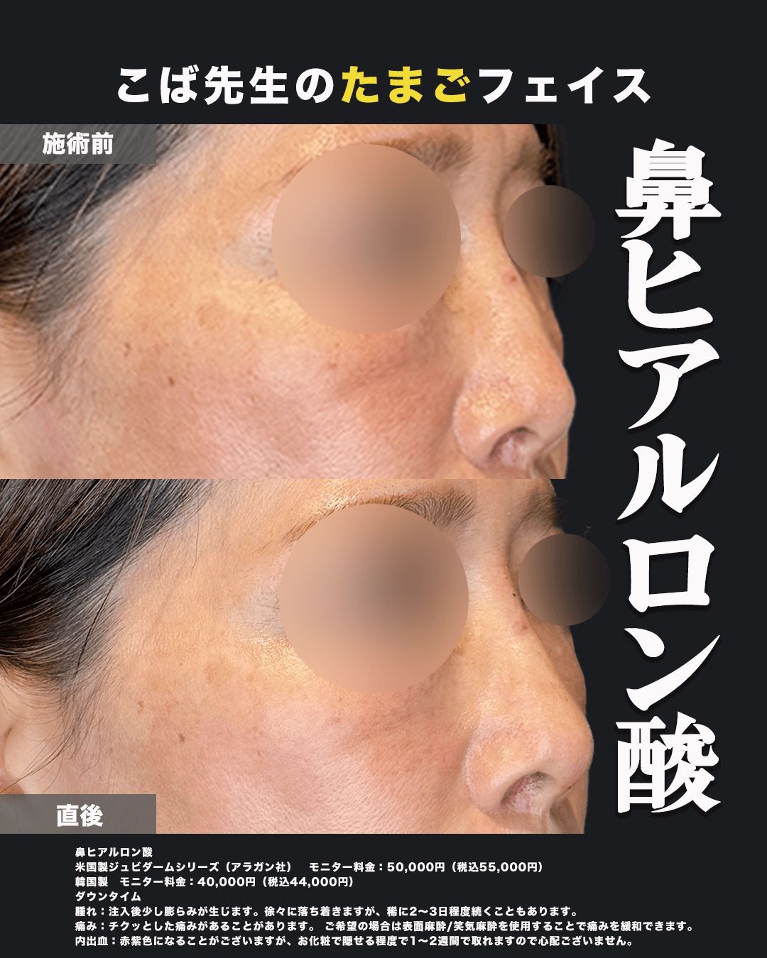 鼻ヒアルロン酸症例写真02（斜め）