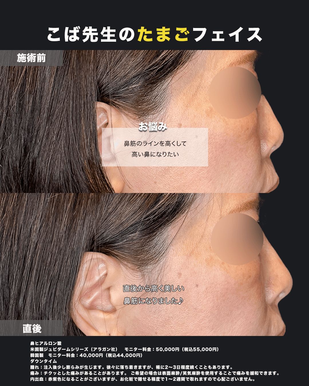 鼻ヒアルロン酸症例写真02（横）