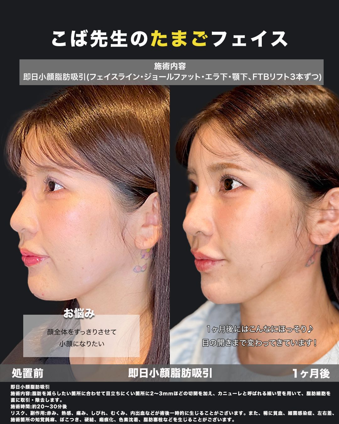 小顔脂肪吸引-症例30（斜め）