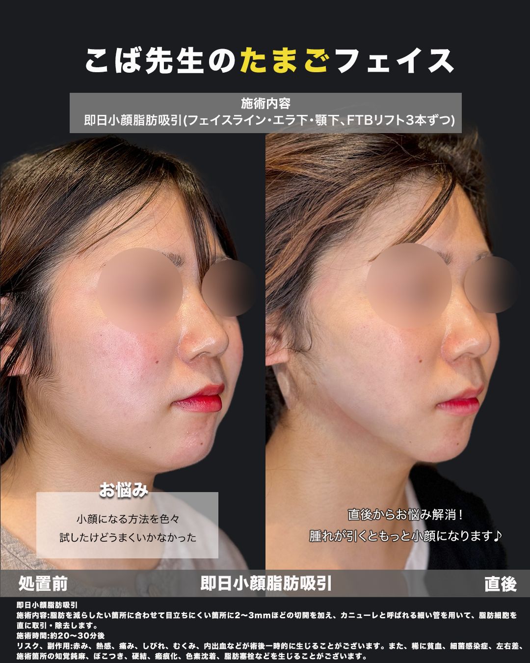 小型脂肪吸引症例写真37（斜め）