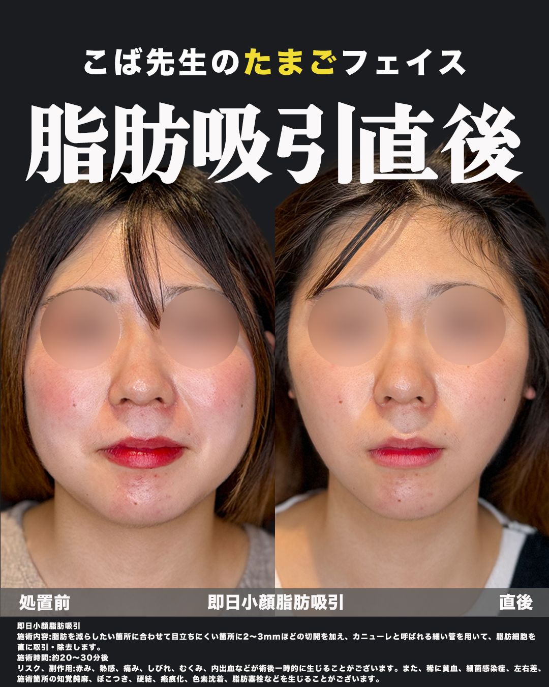 小型脂肪吸引症例写真37（正面）