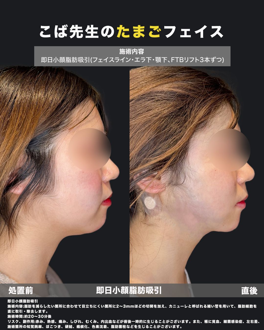 小型脂肪吸引症例写真37（横）