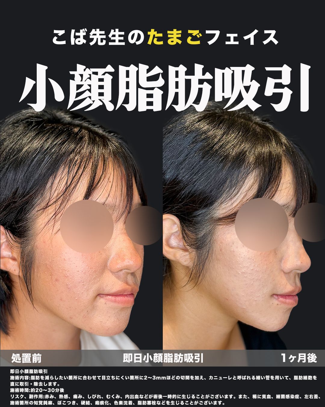 小顔脂肪吸引の症例46（斜め）