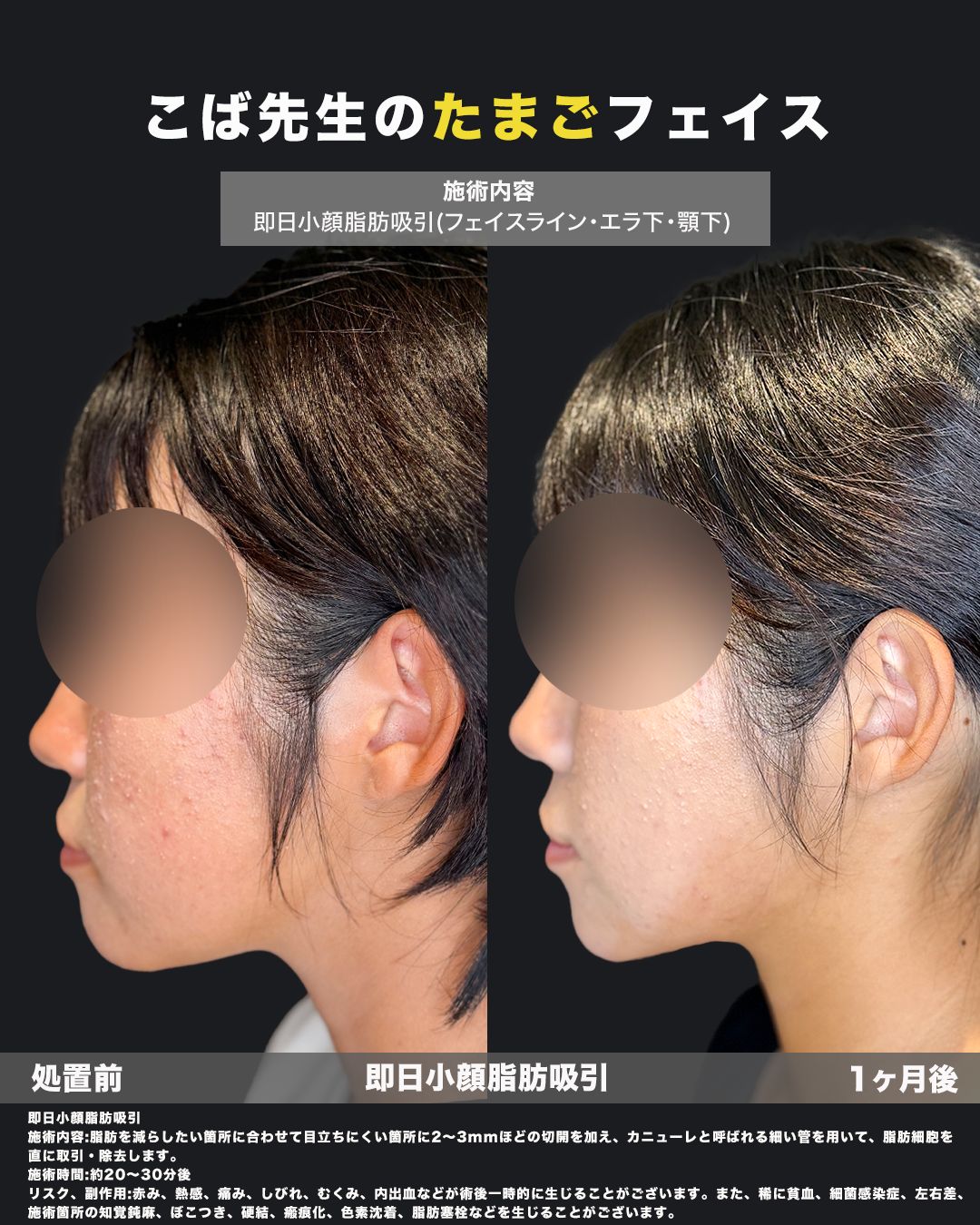 小顔脂肪吸引の症例46（横）