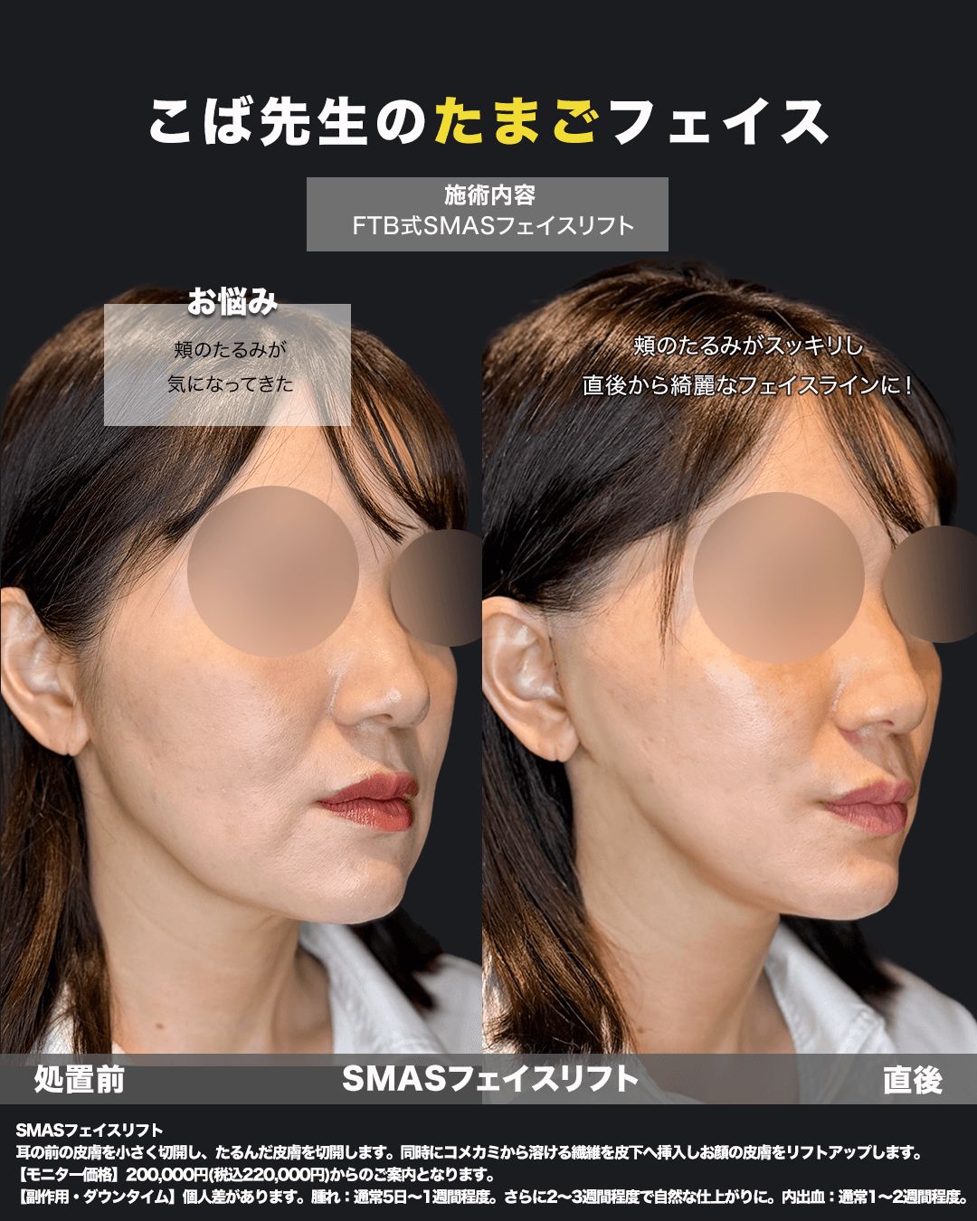 切開リフトの症例写真18（斜め）