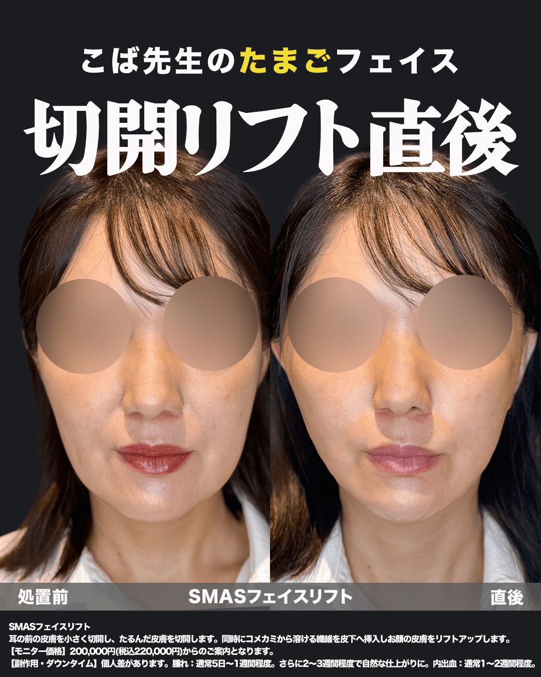 切開リフトの症例写真18（正面）