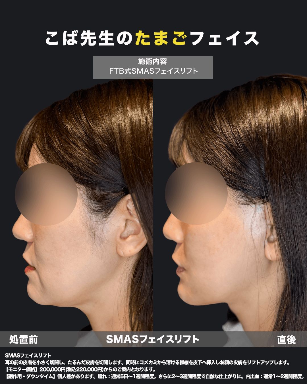 切開リフトの症例写真18（横）