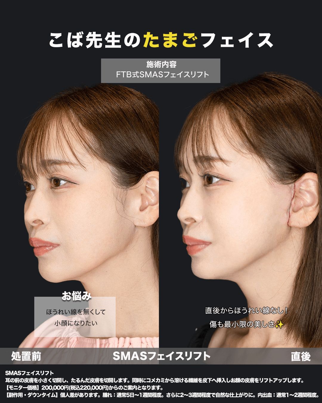 切開リフト直後の症例写真（斜め）