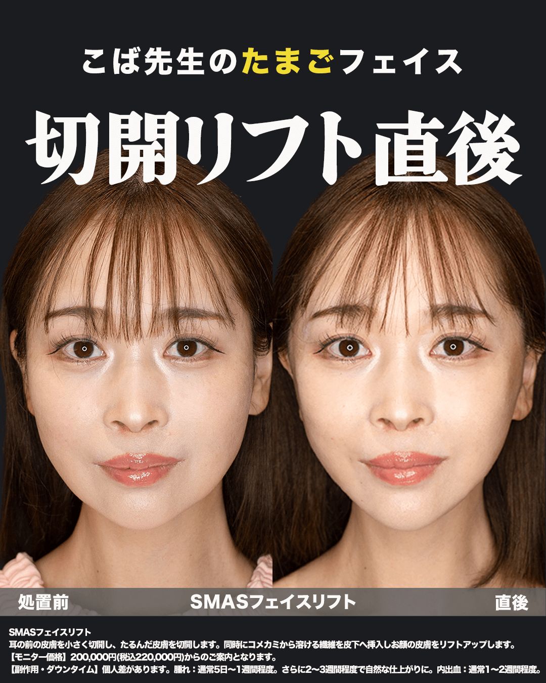 切開リフト直後の症例写真（正面）