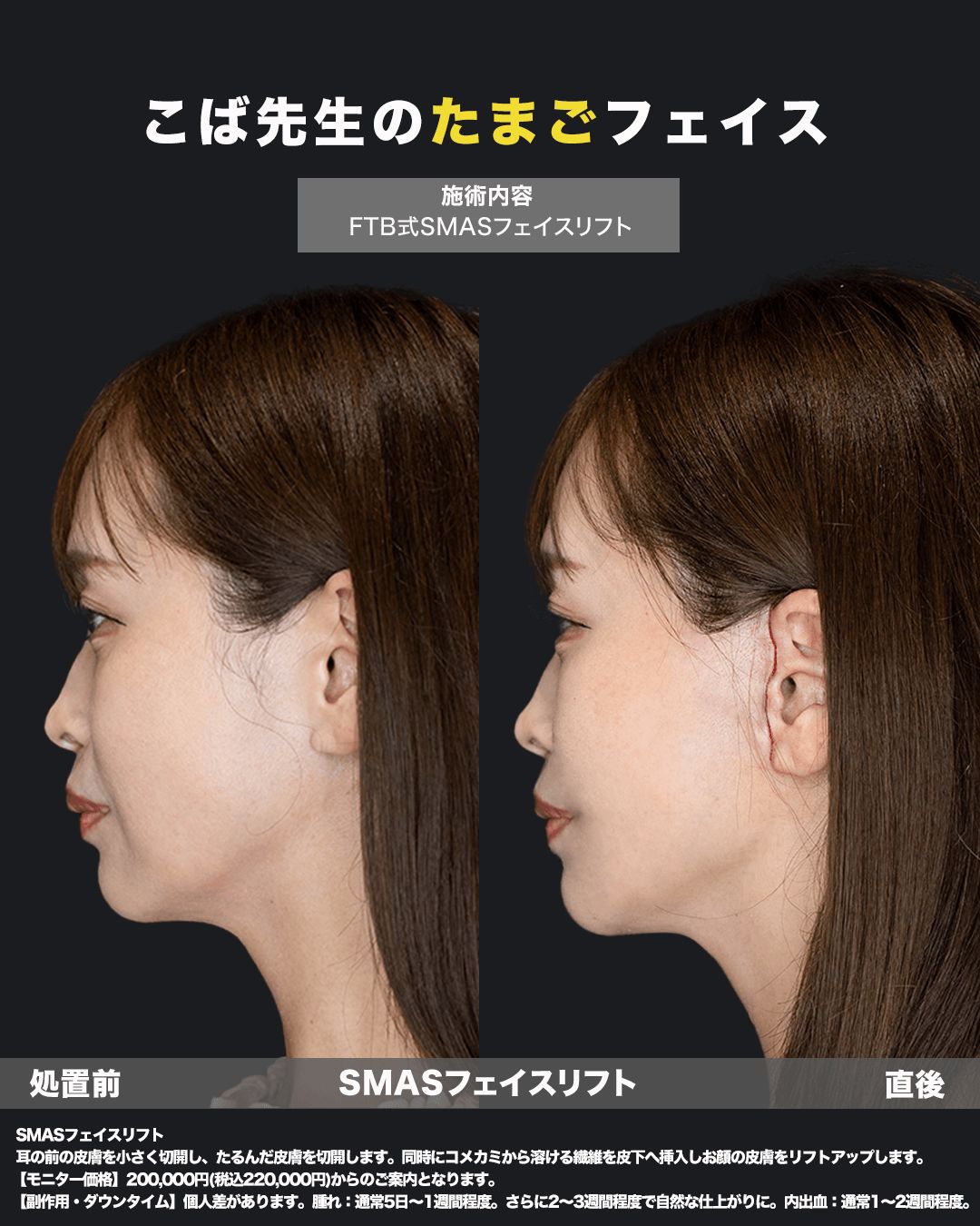 切開リフト直後の症例写真（横）