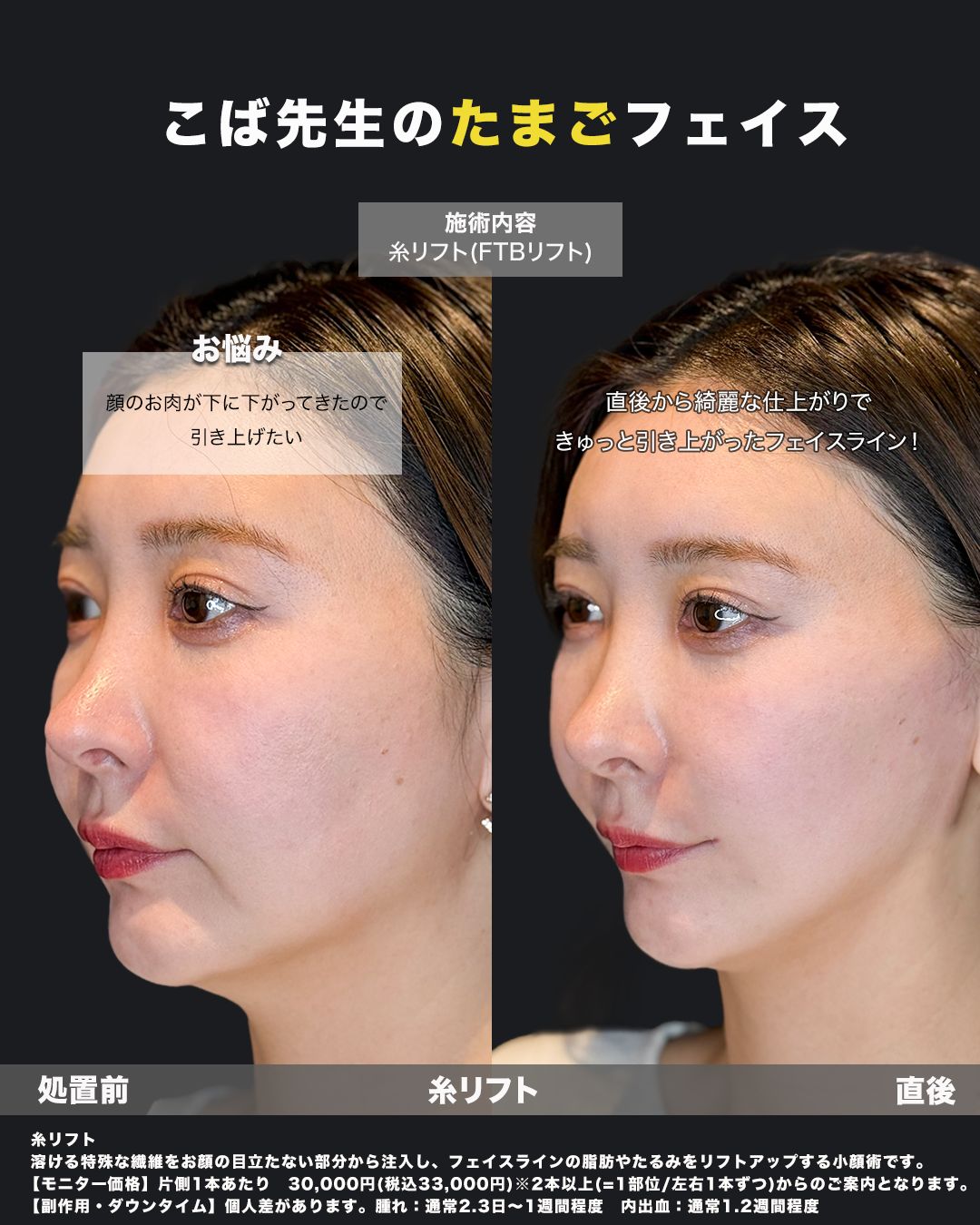 糸リフト直後の症例写真（斜め）