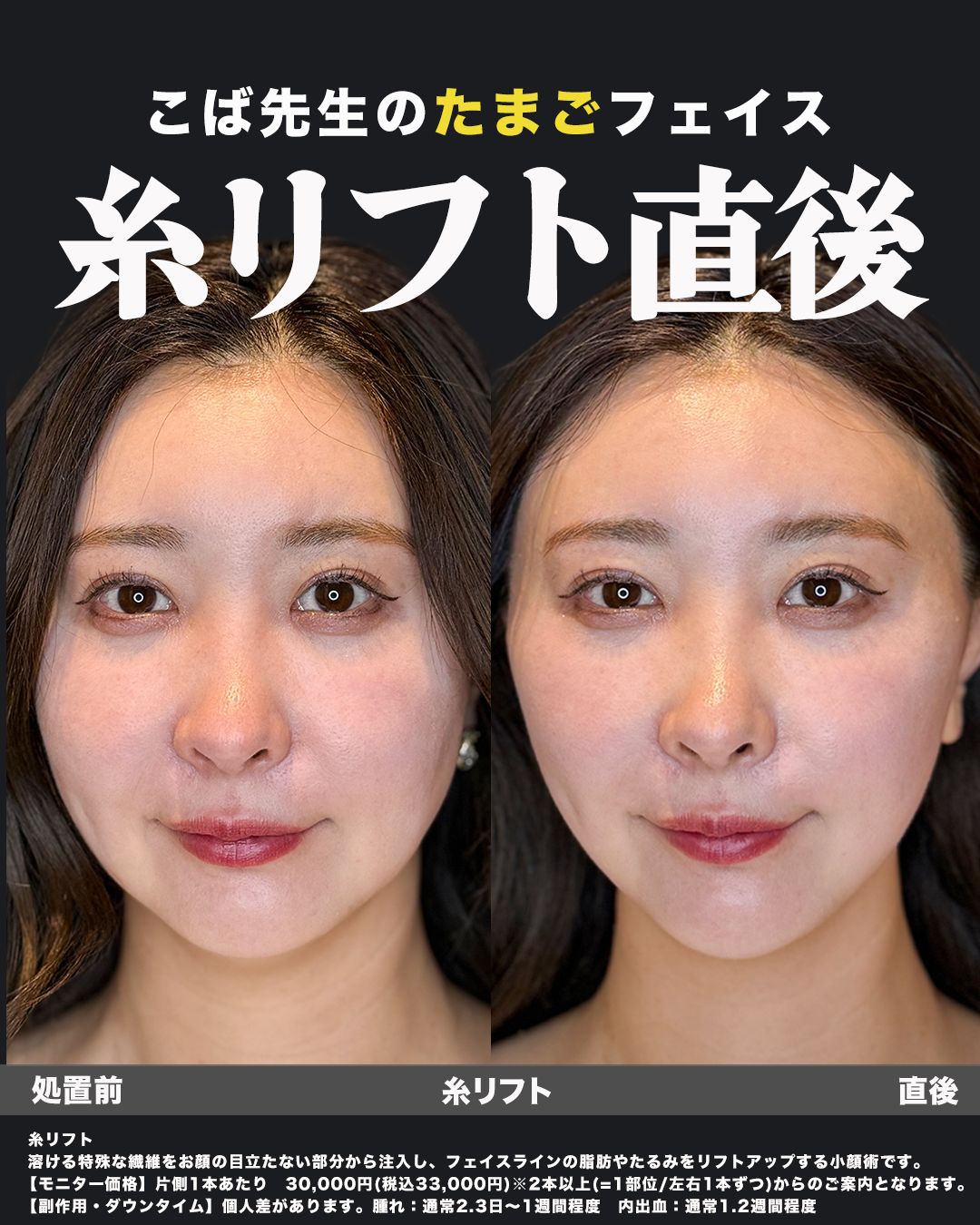 糸リフト直後の症例写真（正面）