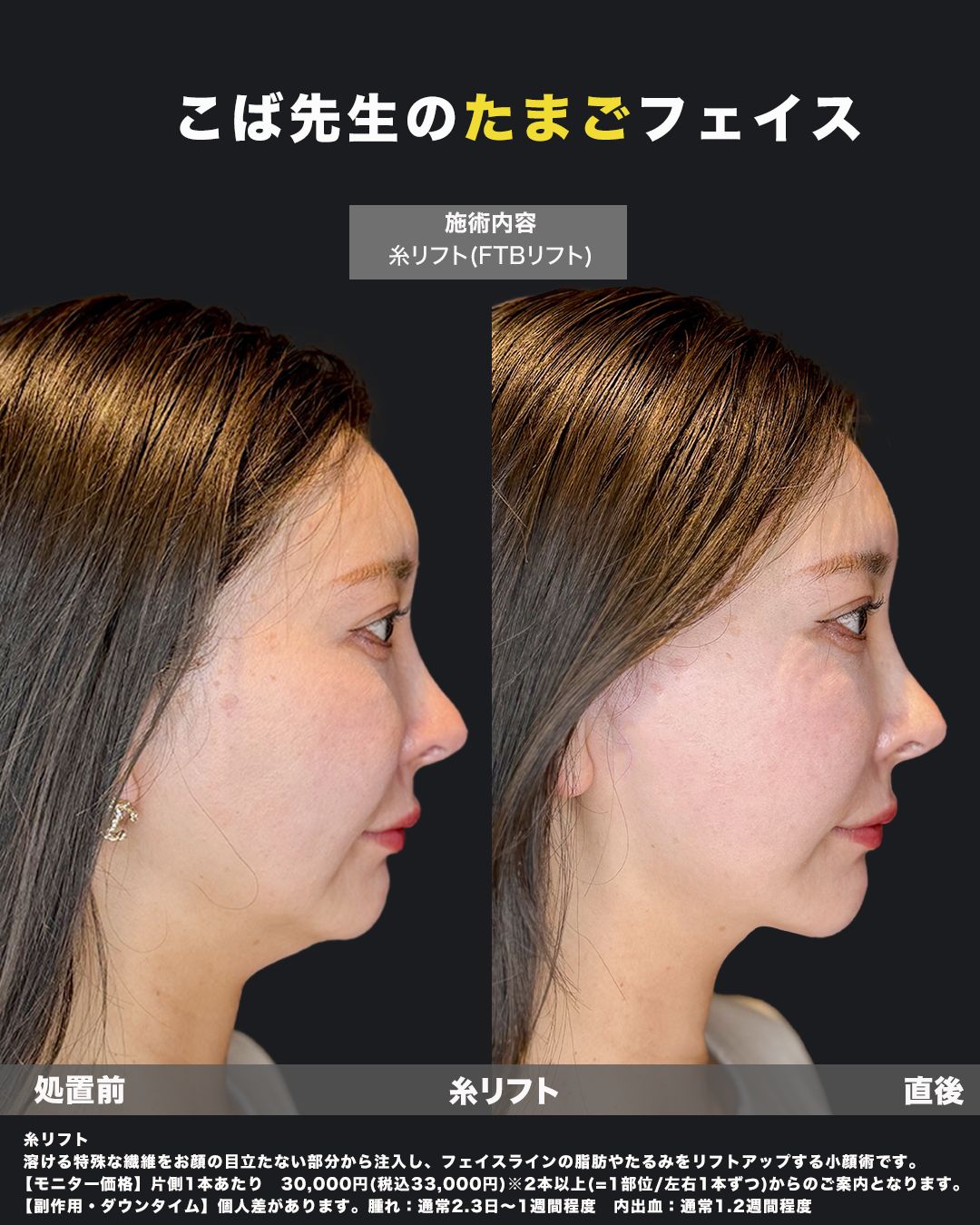 糸リフト直後の症例写真（横）