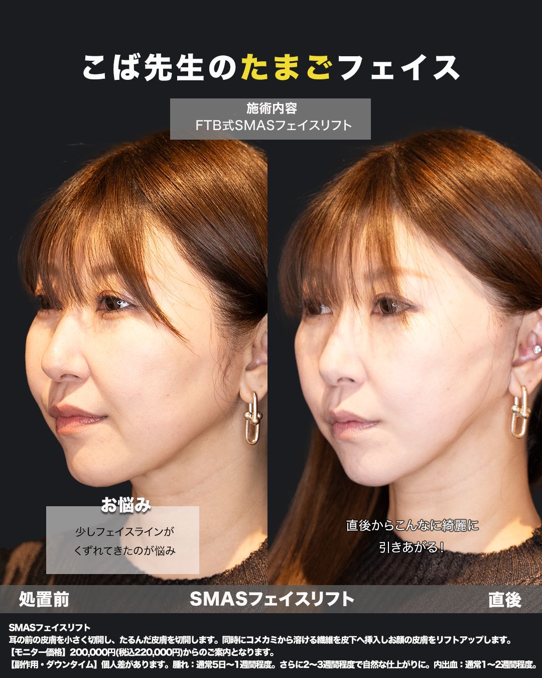 切開リフトの症例写真（斜め）