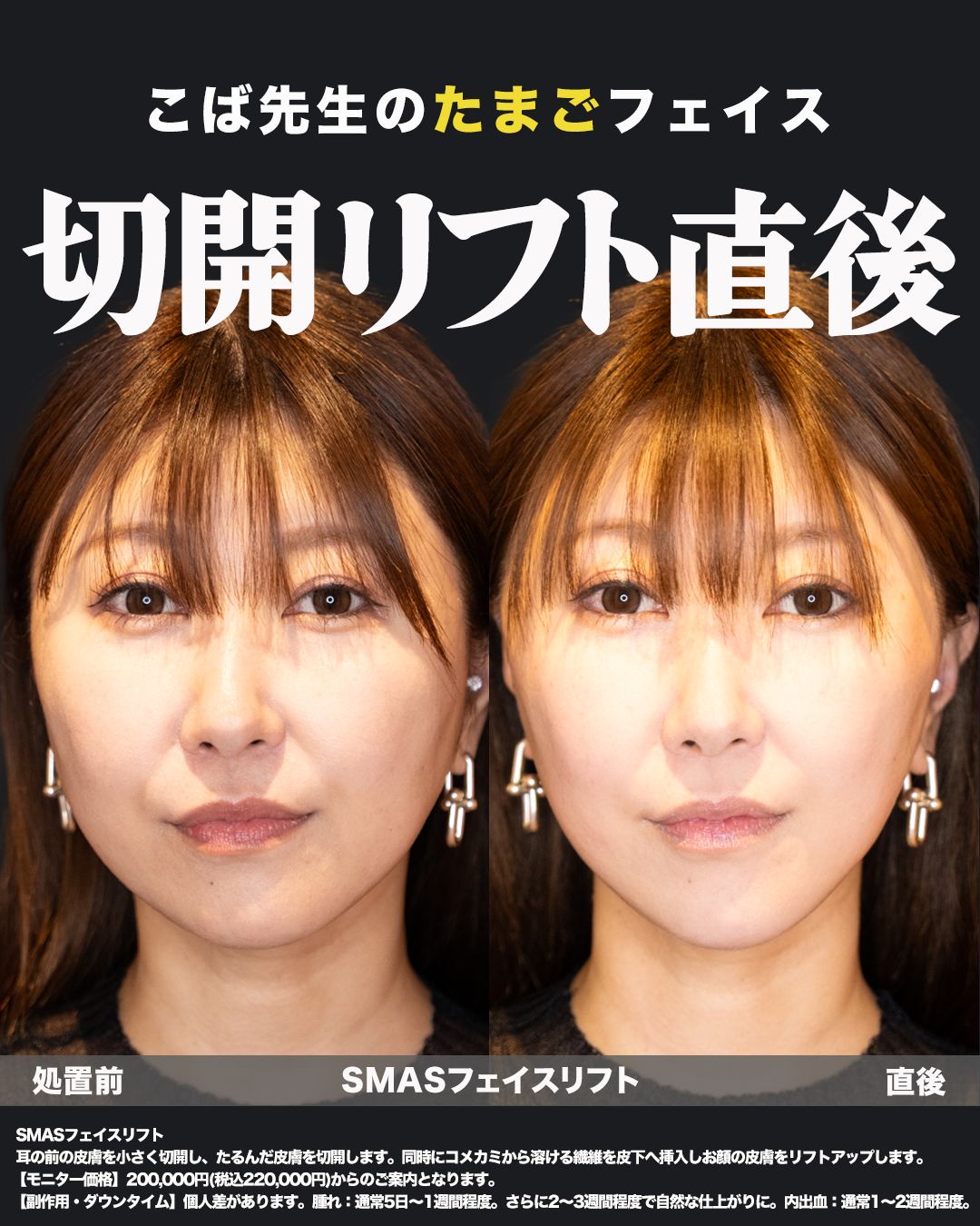 切開リフトの症例写真（正面）