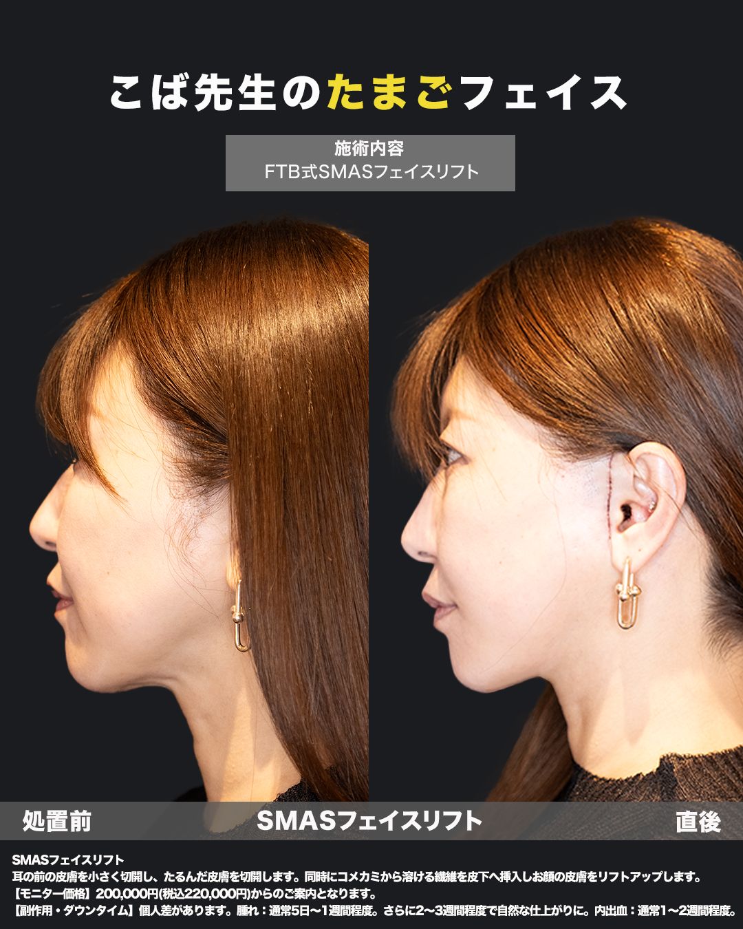 切開リフトの症例写真（横）