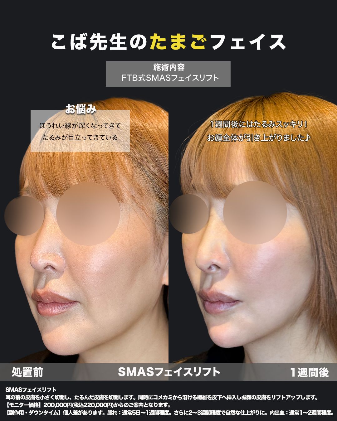 切開リフト症例19（斜め）