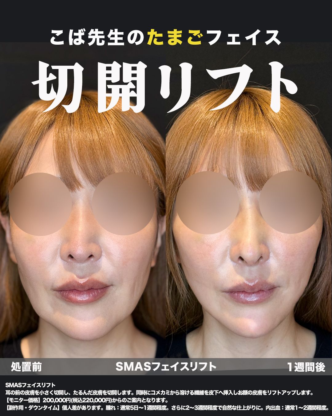 切開リフト症例19（正面）