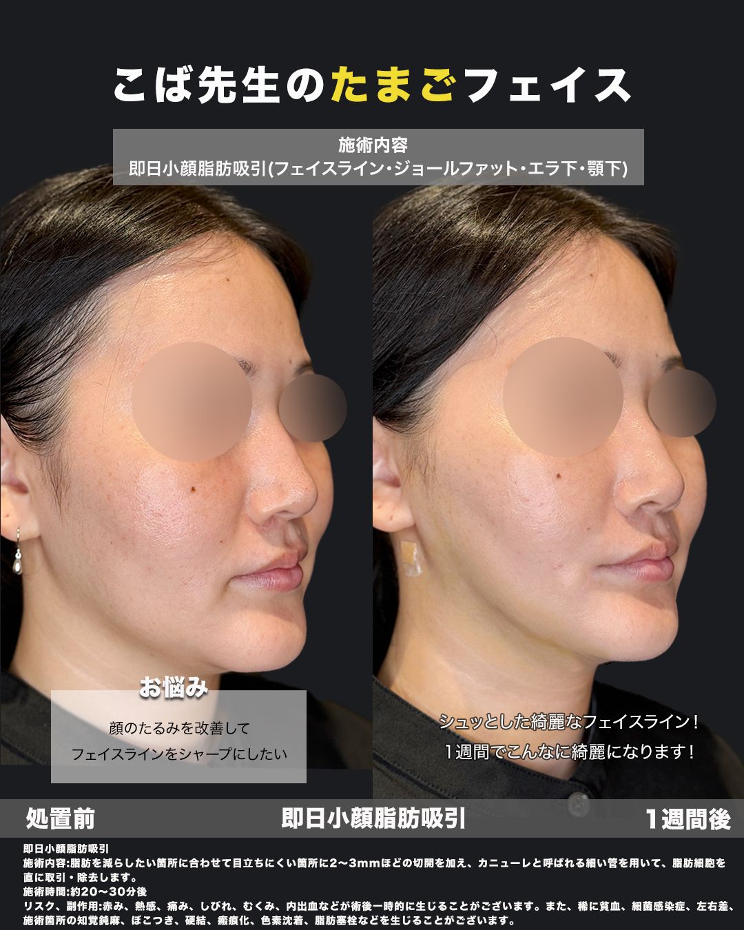 脂肪吸引の症例写真42（斜め）