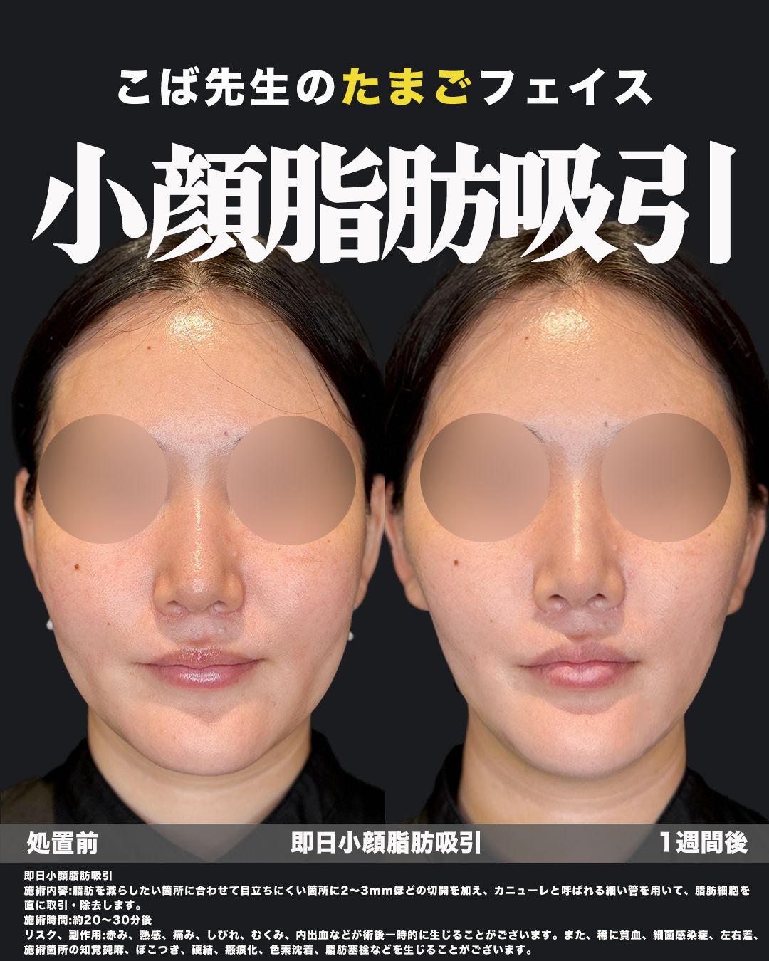 脂肪吸引の症例写真42（正面）