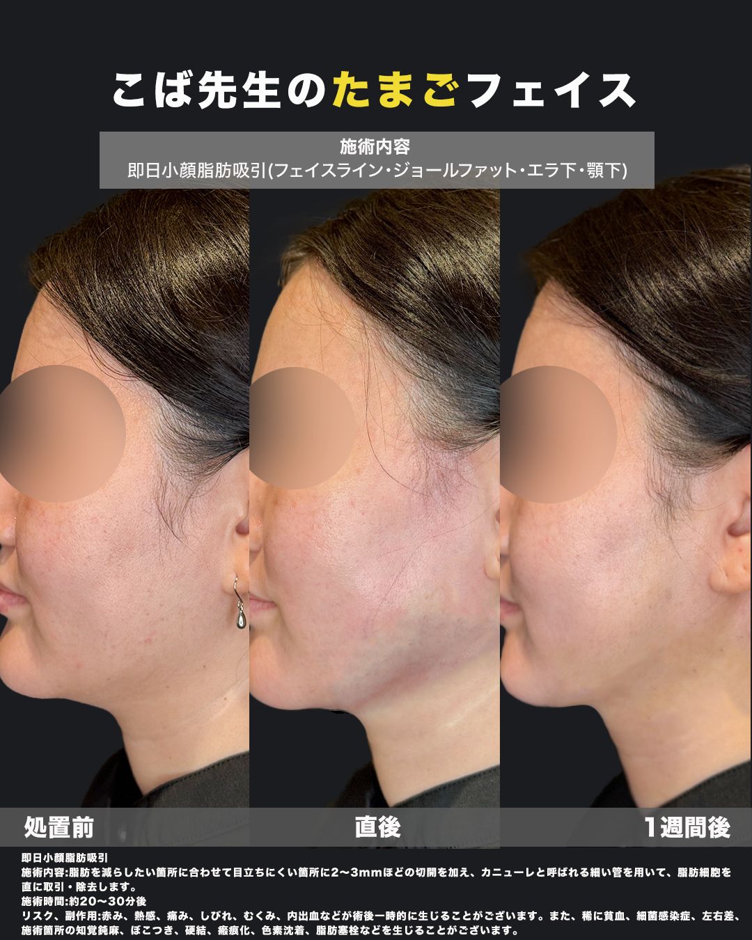 脂肪吸引の症例写真42（横2）