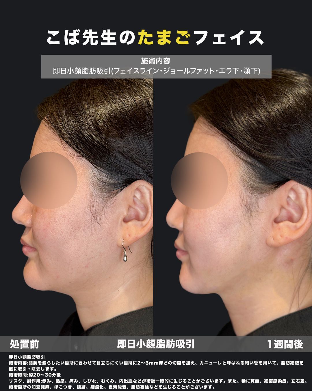 脂肪吸引の症例写真42（横）