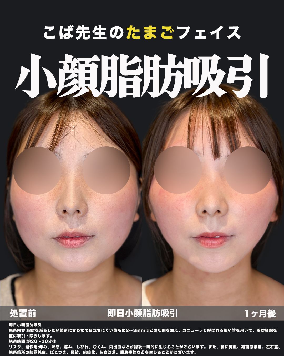 小顔脂肪吸引の症例写真（正面）