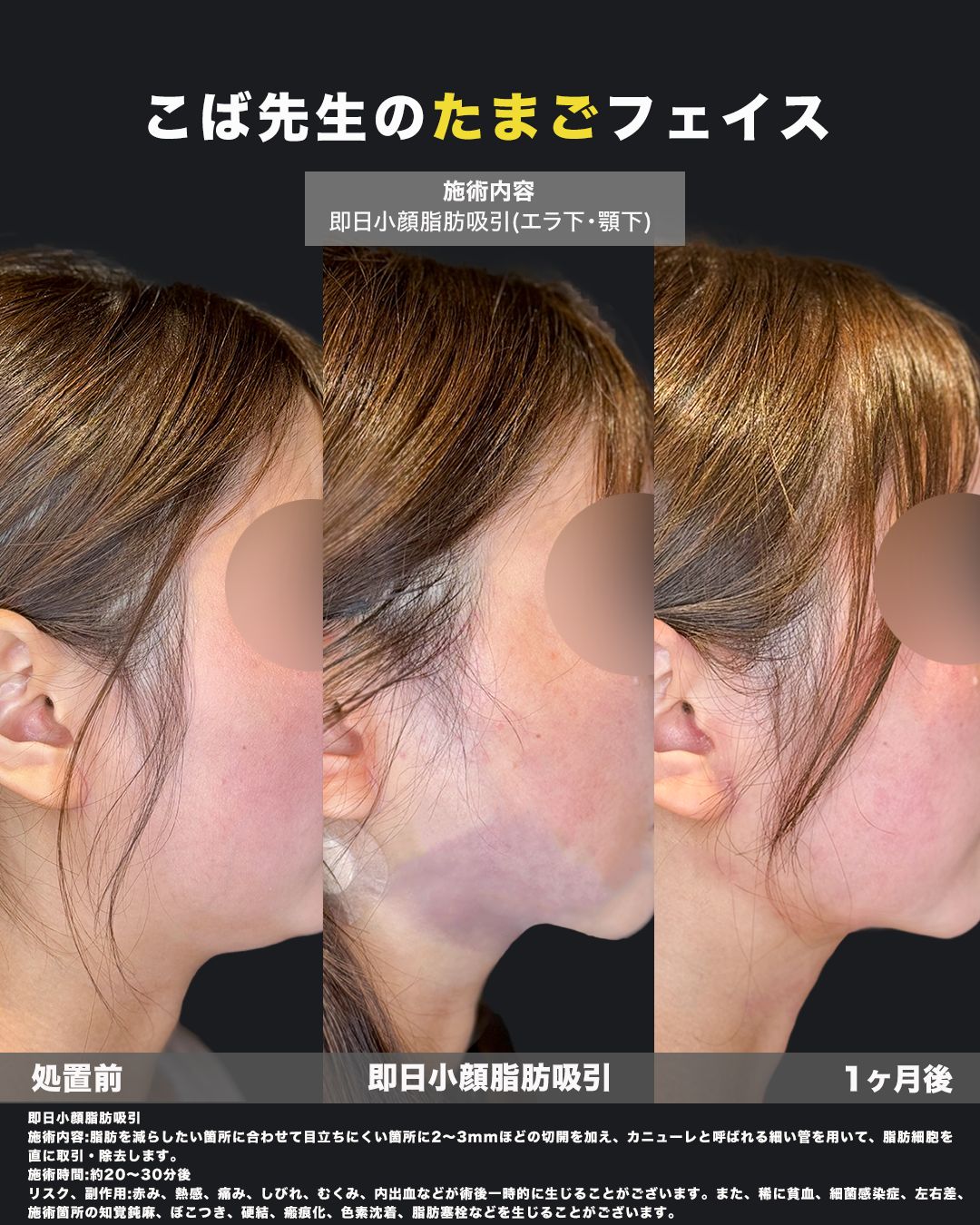 小顔脂肪吸引の症例写真（内出血）