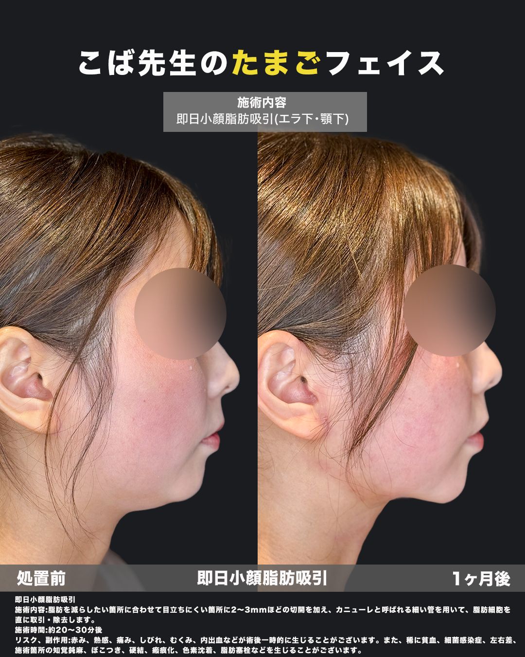 小顔脂肪吸引の症例写真（横）