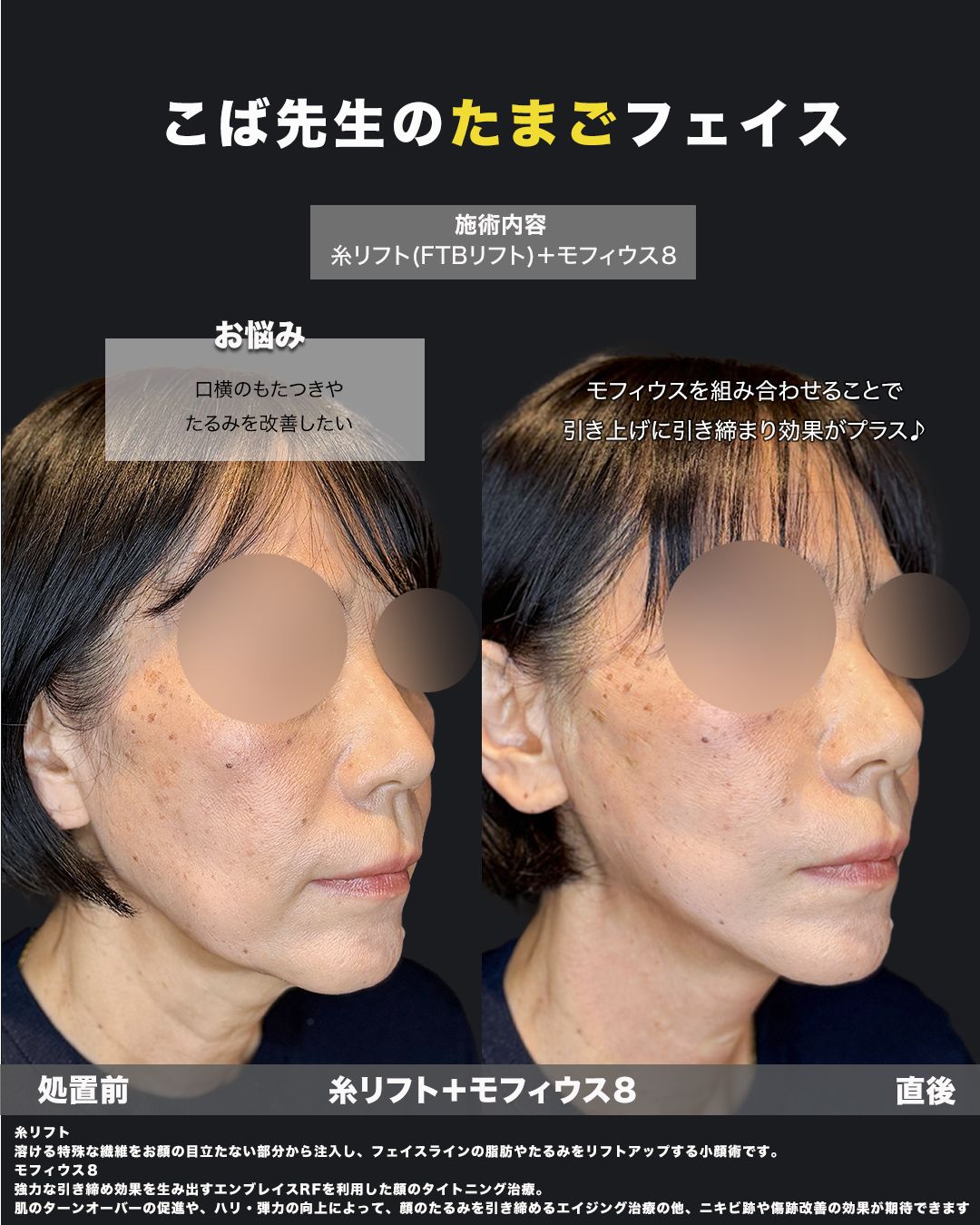 糸リフト＋モフィウス8の症例写真（斜め）