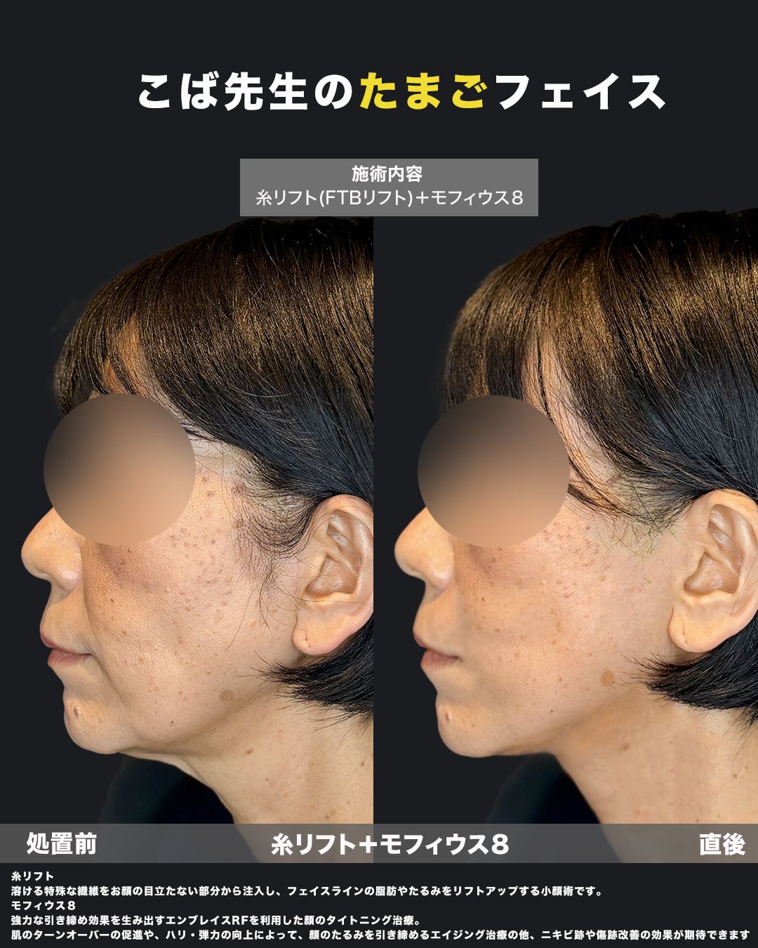 糸リフト＋モフィウス8の症例写真（横）