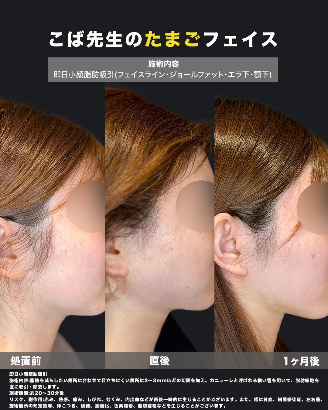 小顔脂肪吸引の症例53（比較）