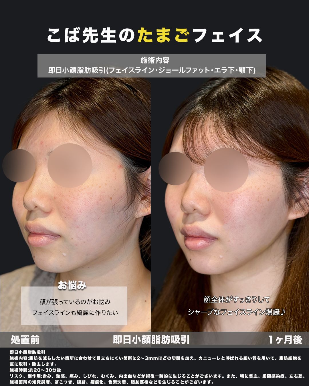 小顔脂肪吸引の症例53（斜め）