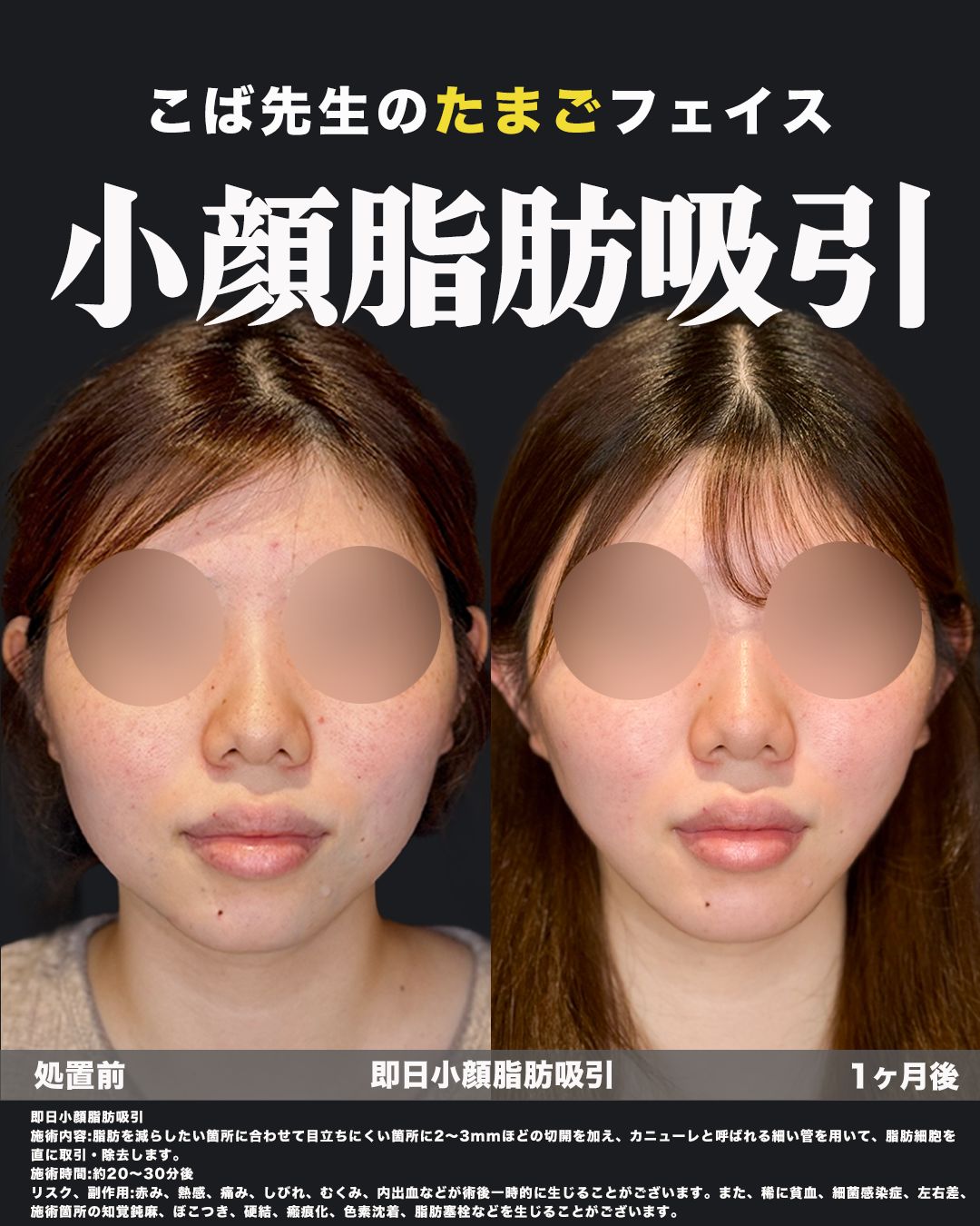 小顔脂肪吸引の症例53（正面）