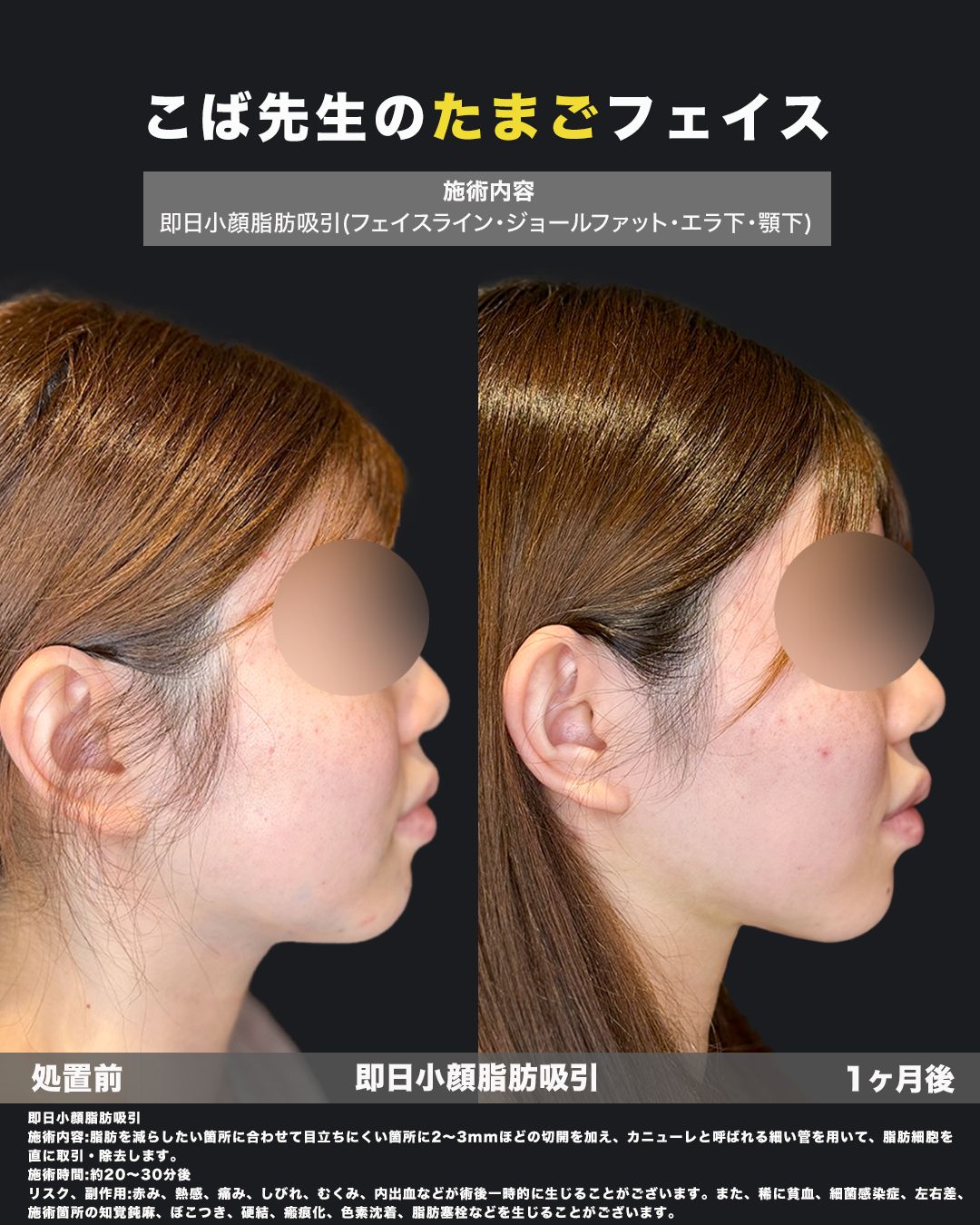 小顔脂肪吸引の症例53（横）