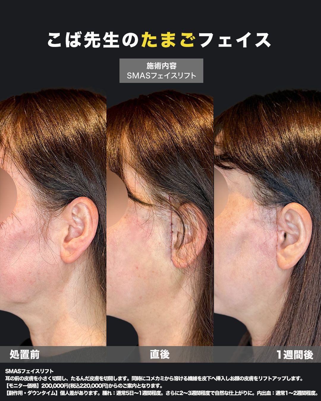 切開リフトの症例50代女性（比較）