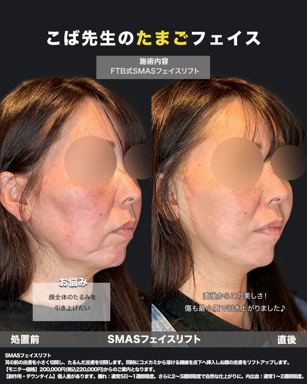 切開リフトの症例50代女性（斜め）