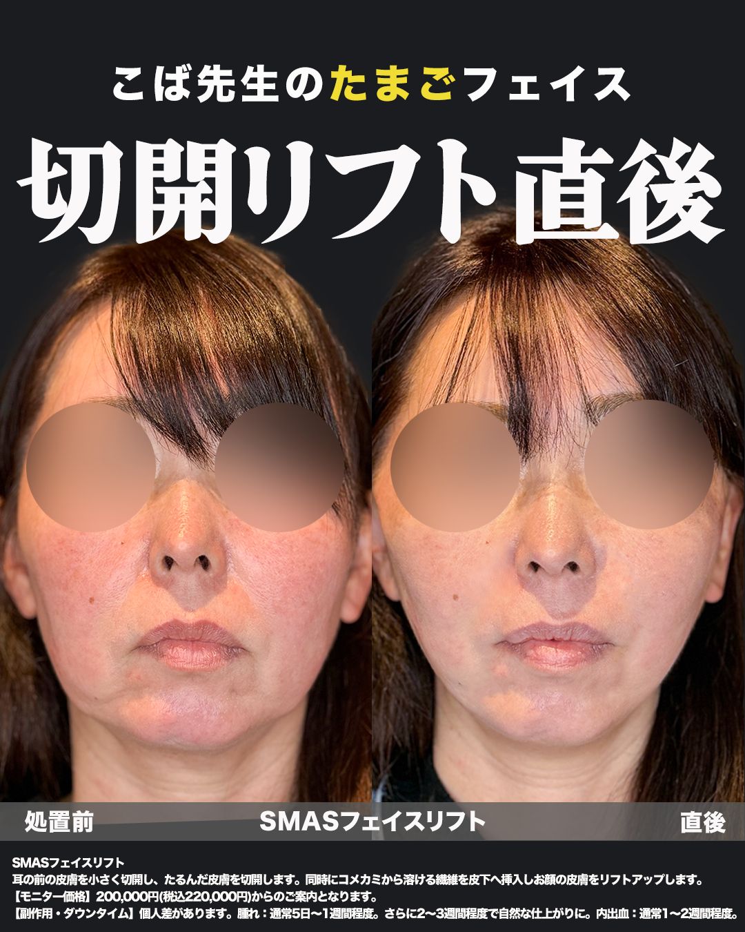 切開リフトの症例50代女性（正面）