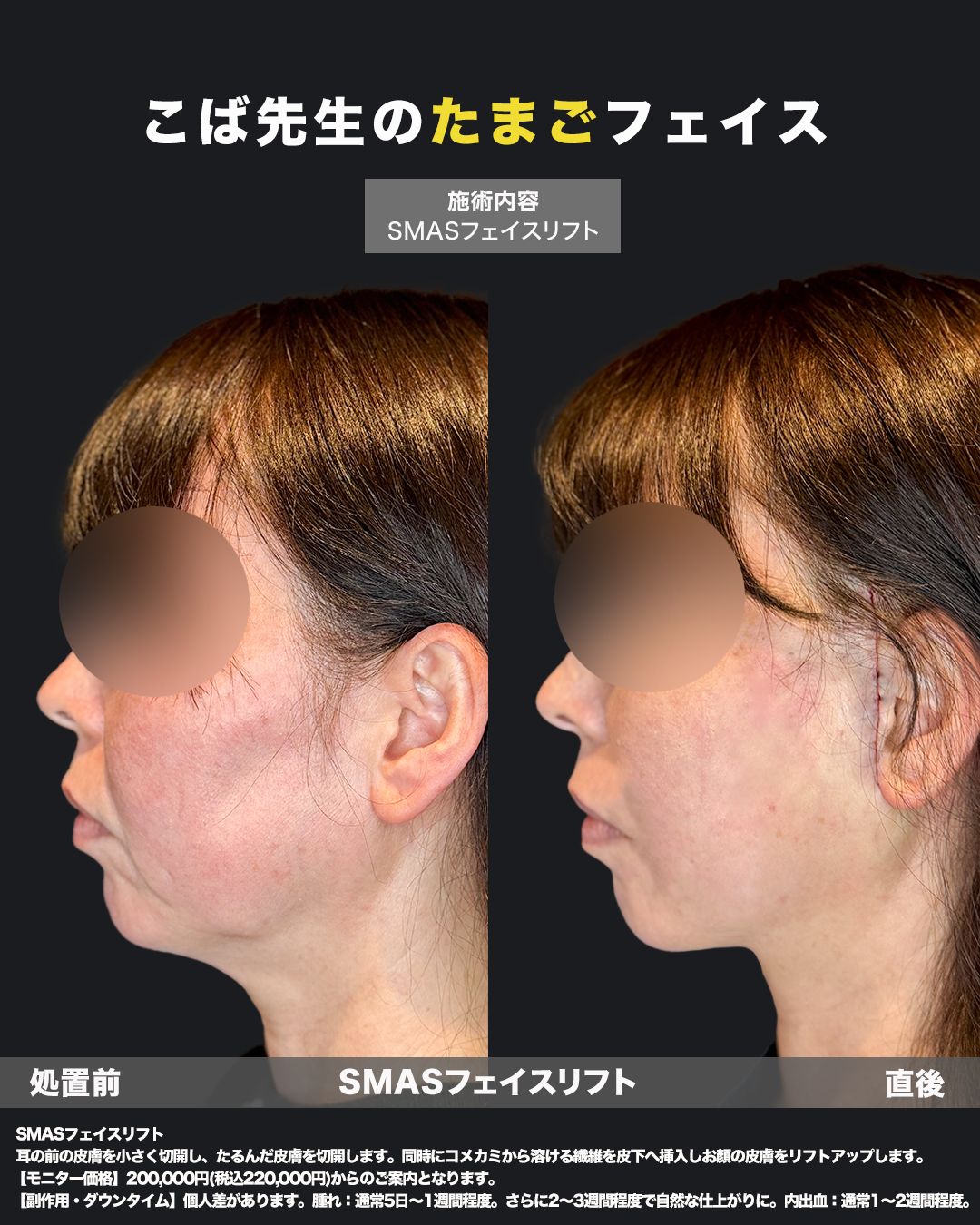 切開リフトの症例50代女性（横）