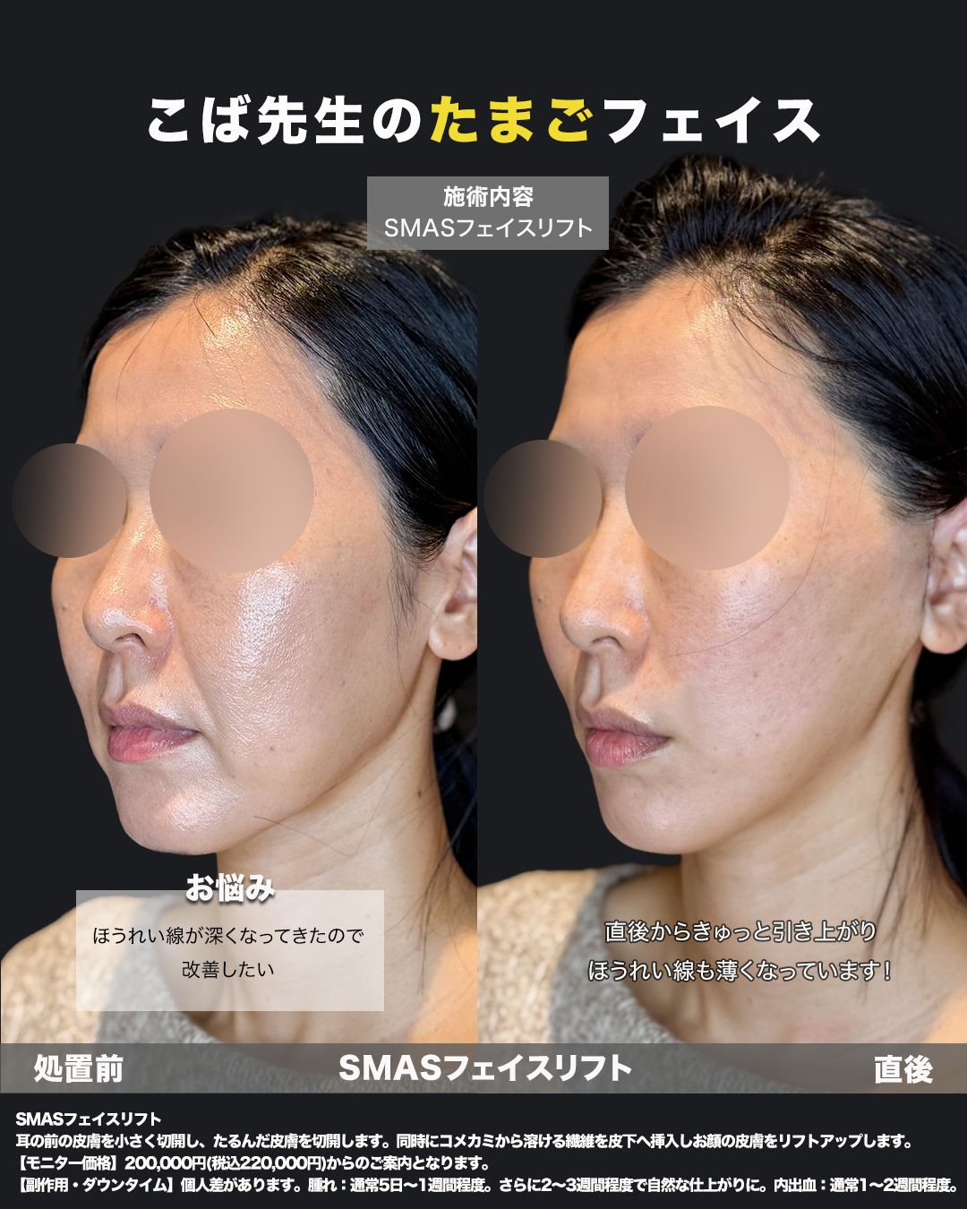 切開リフト症例22（斜め）