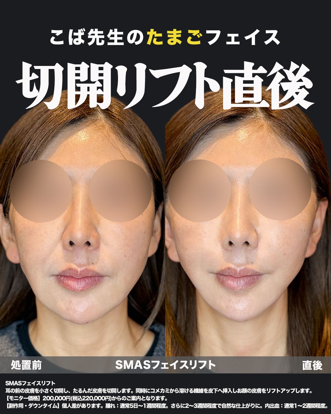 切開リフト症例写真21（正面）