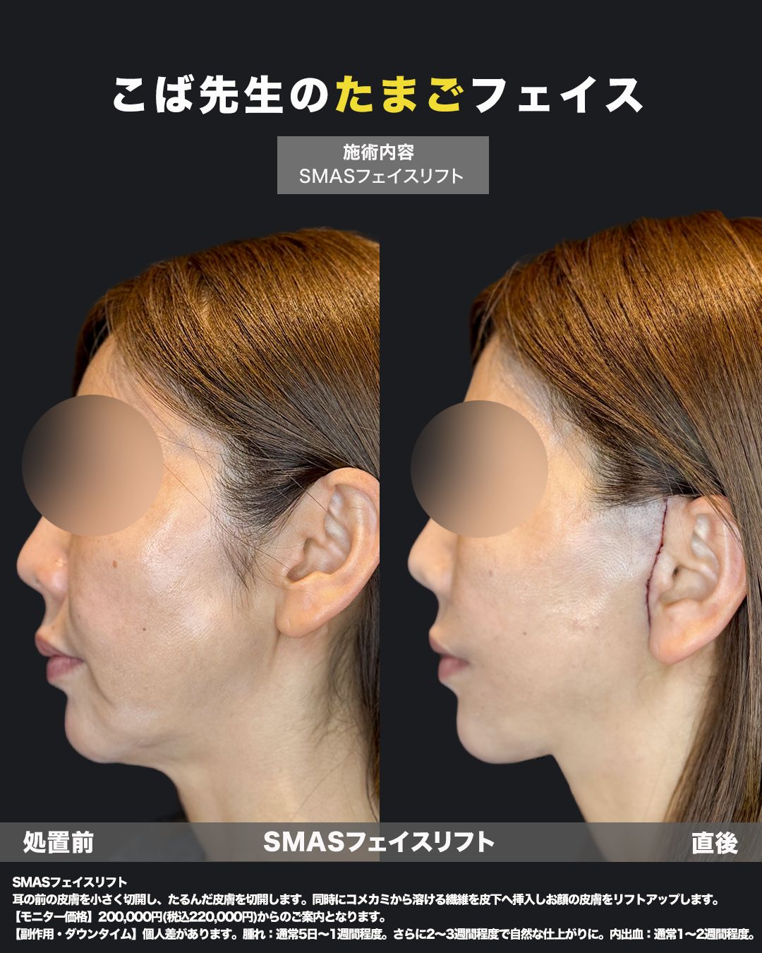 切開リフト症例写真21（横）