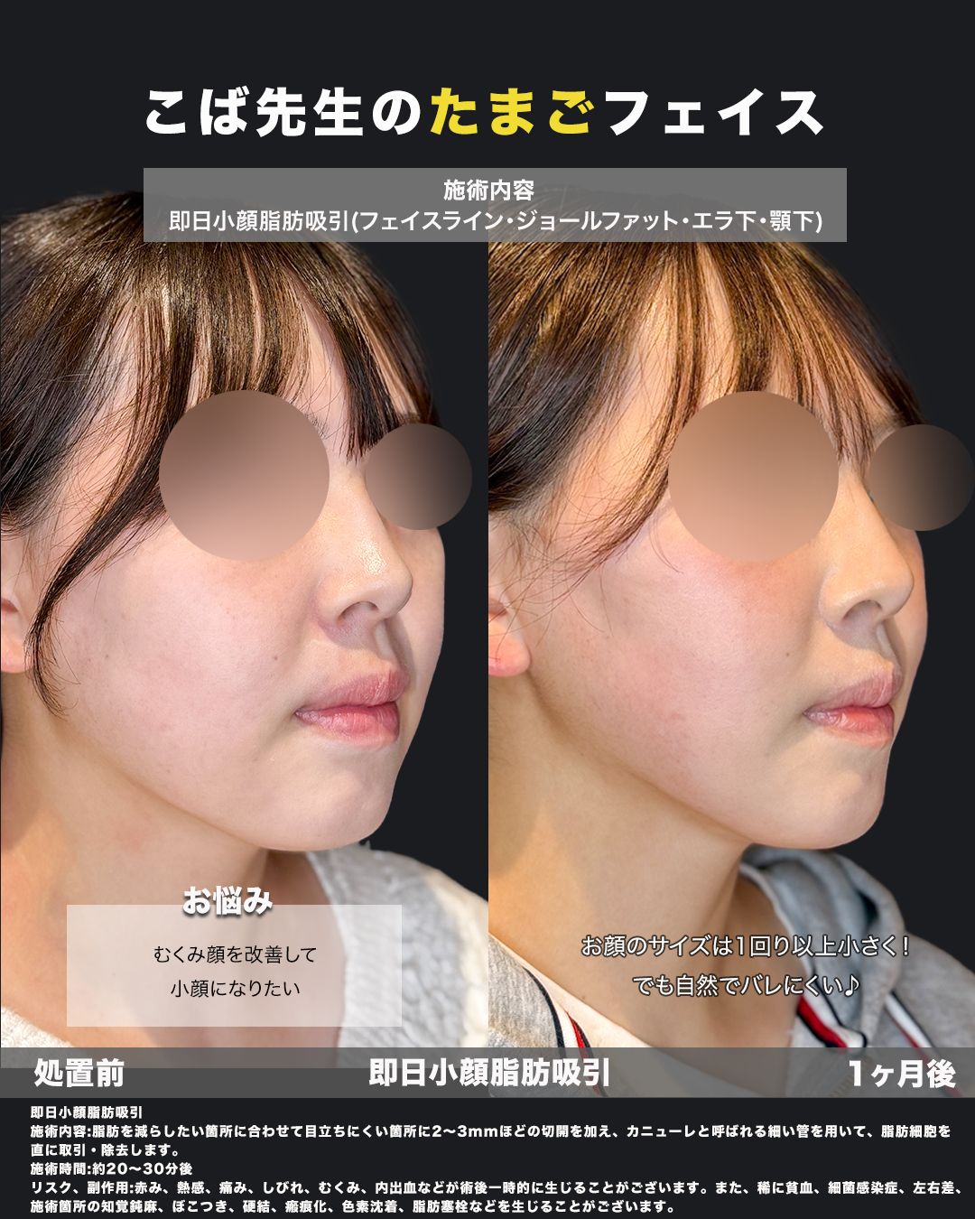 脂肪吸引症例48（斜め）