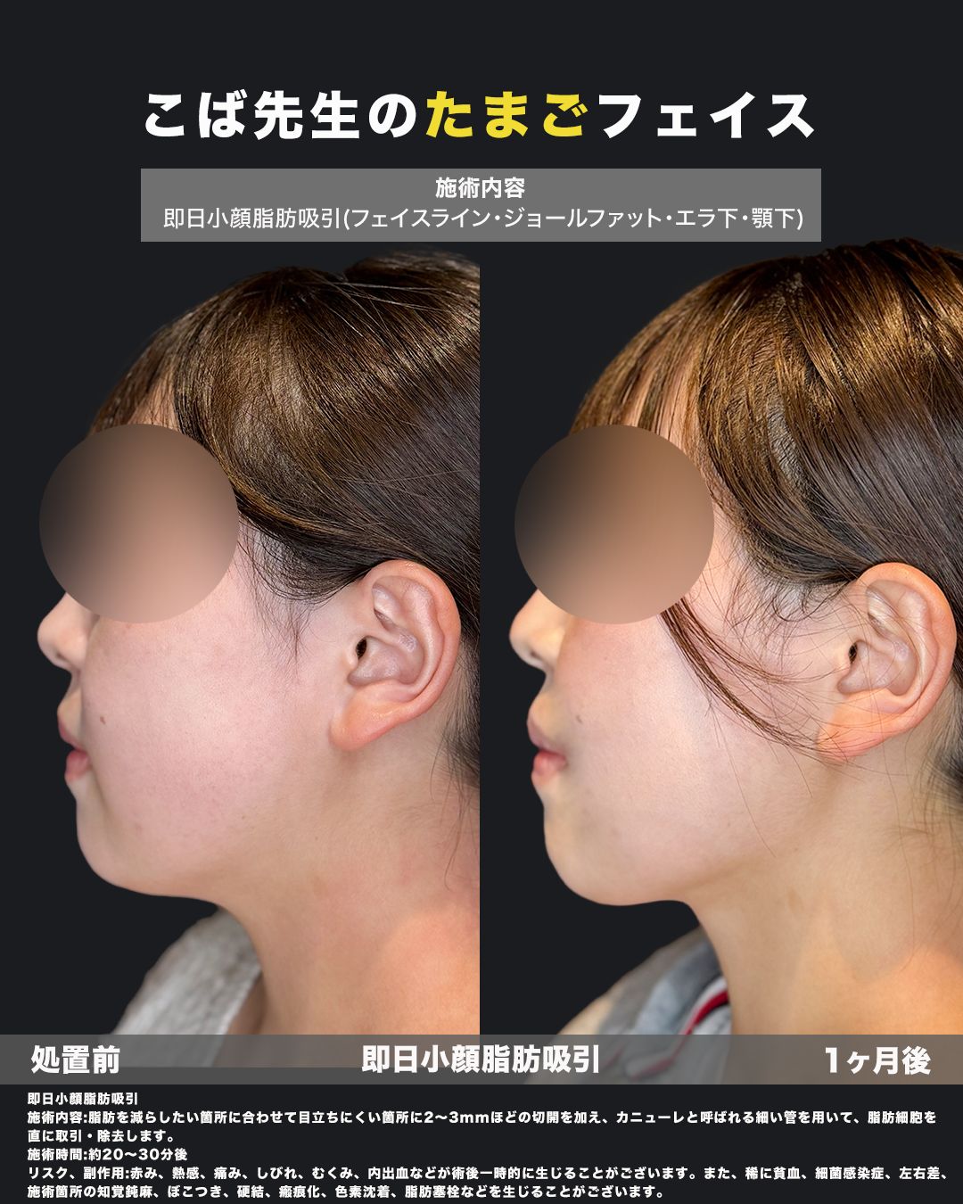 脂肪吸引症例48（横）