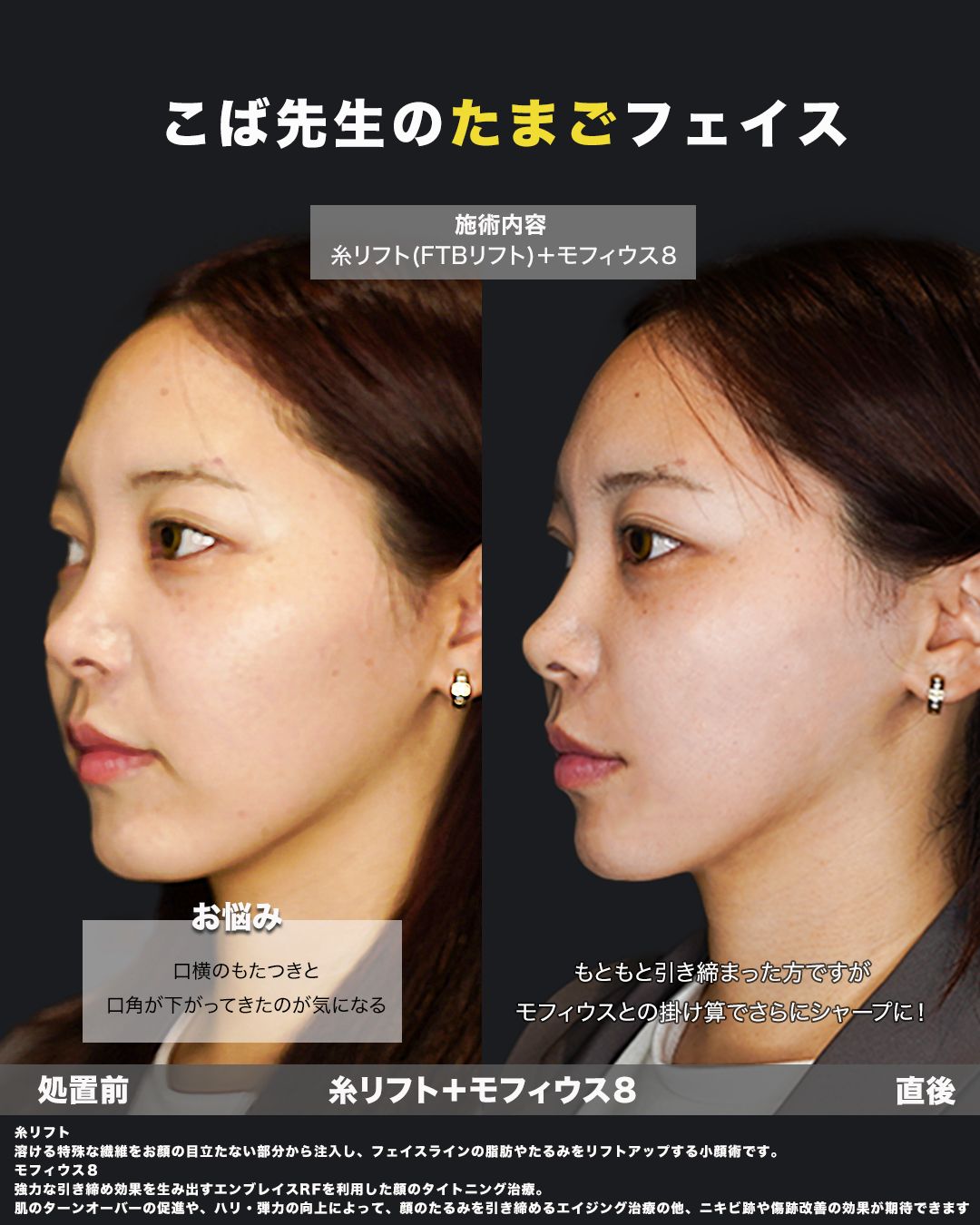 糸リフト＋モフィウス8の症例28（斜め）