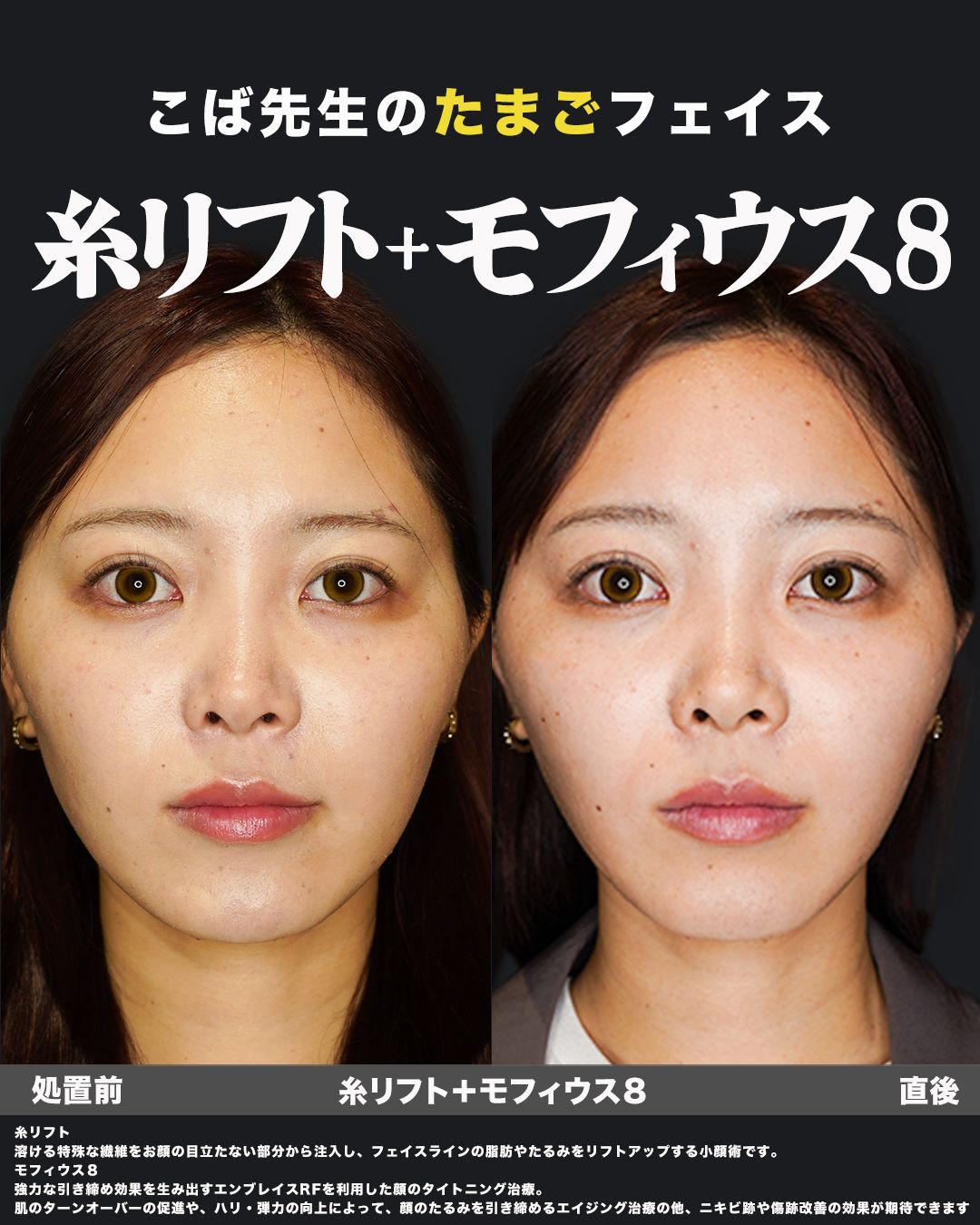 糸リフト＋モフィウス8の症例28（正面）