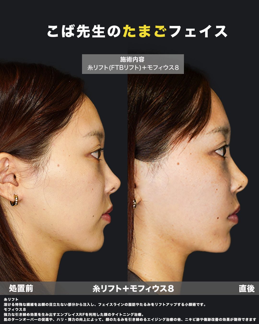 糸リフト＋モフィウス8の症例28（横）