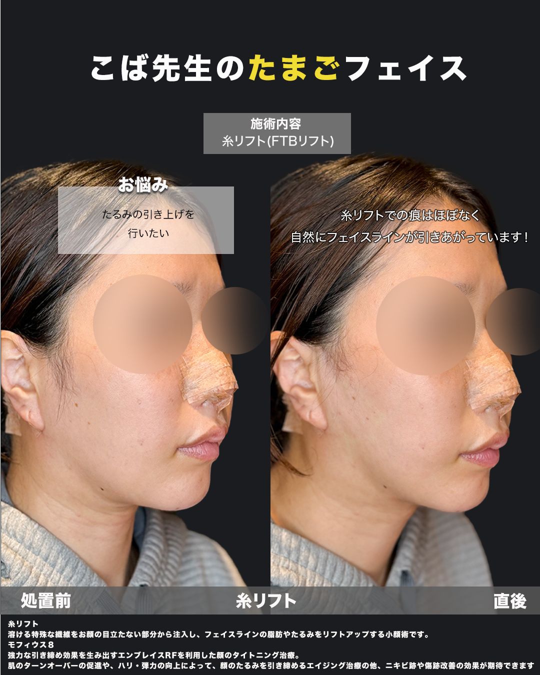 糸リフトの症例25（斜め）