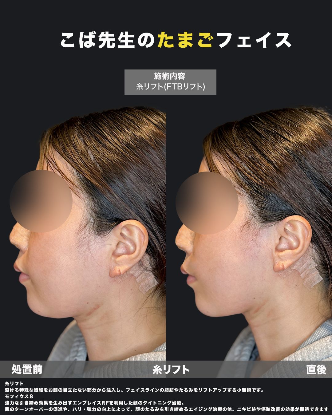 糸リフトの症例25（横）