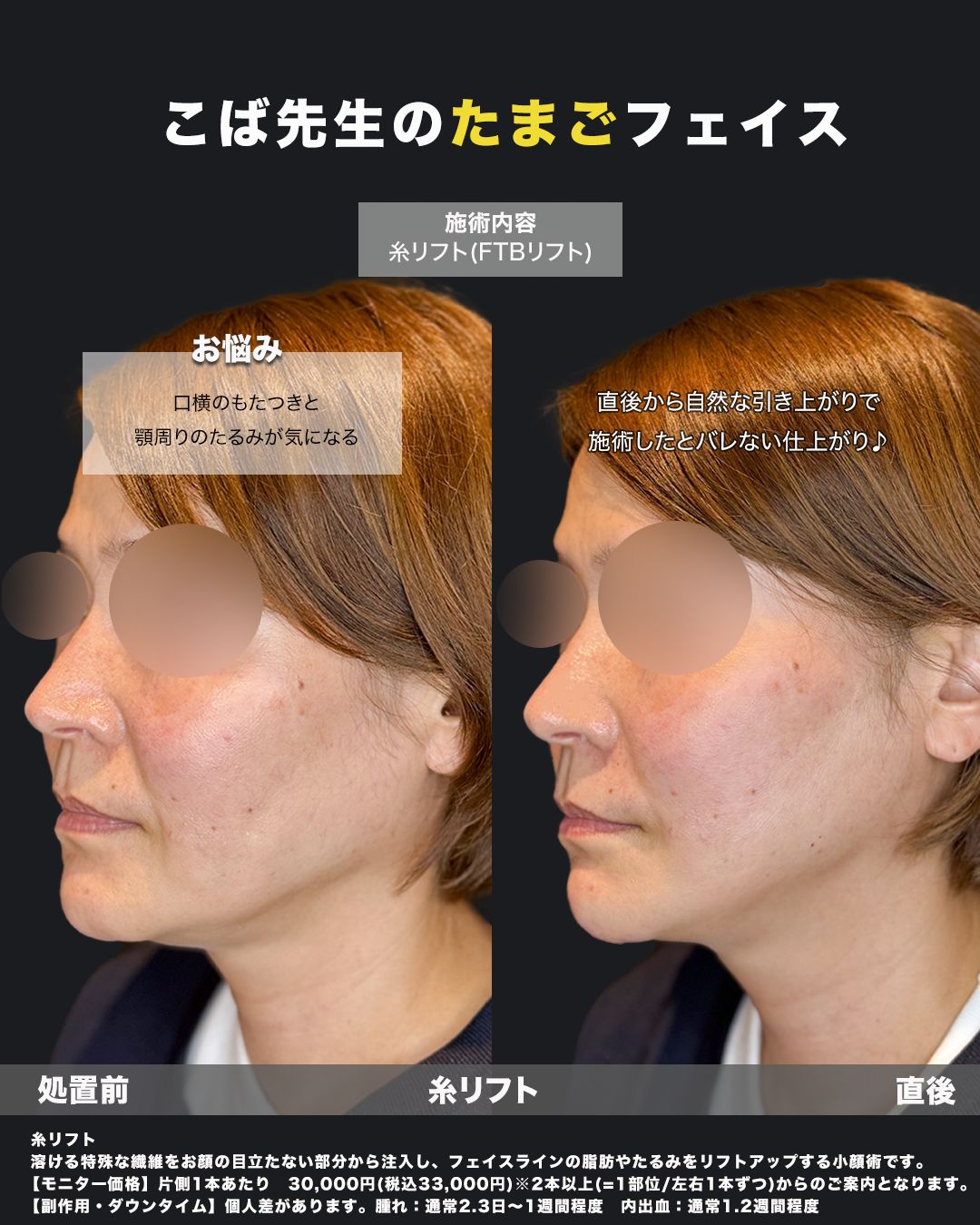 糸リフトの症例写真24（斜め）